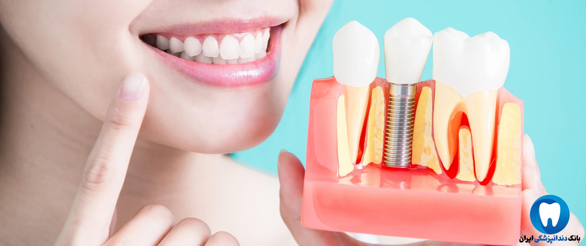 کاشت دندان در بهترین کلینیک دندانپزشکی زیبایی در قزوین