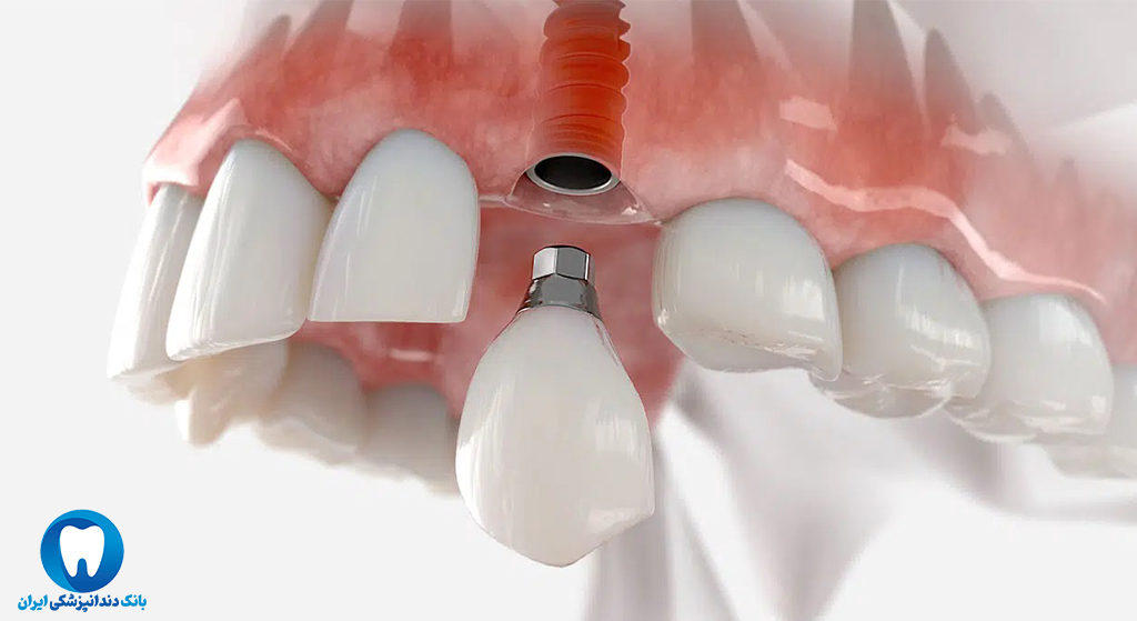 بهترین کلینیک دندانپزشکی تخصصی ایمپلنت دندان در قزوین