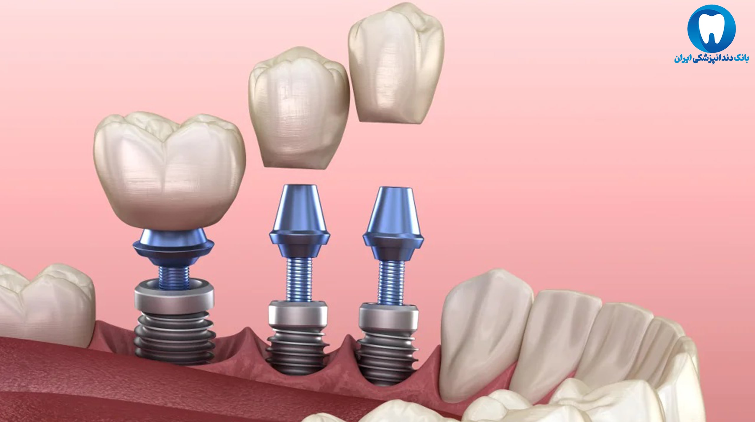 انواع ایمپلنت دندان در مشهد