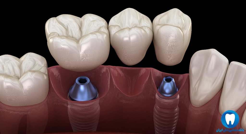 نوع مواد ایمپلنت دندان