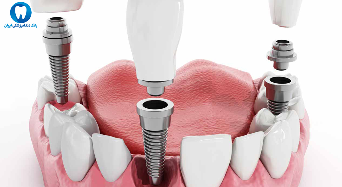بهترین دندانپزشک متخصص ایمپلنت دندان در ارومیه