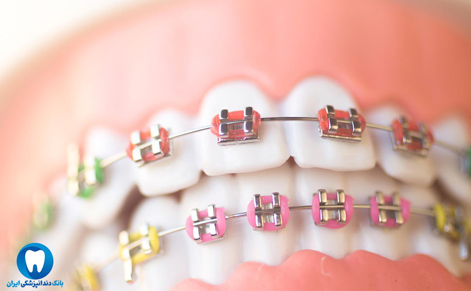 ارتودنسی دندان در بهترین کلینیک دندانپزشکی ارتودنسی در تبریز