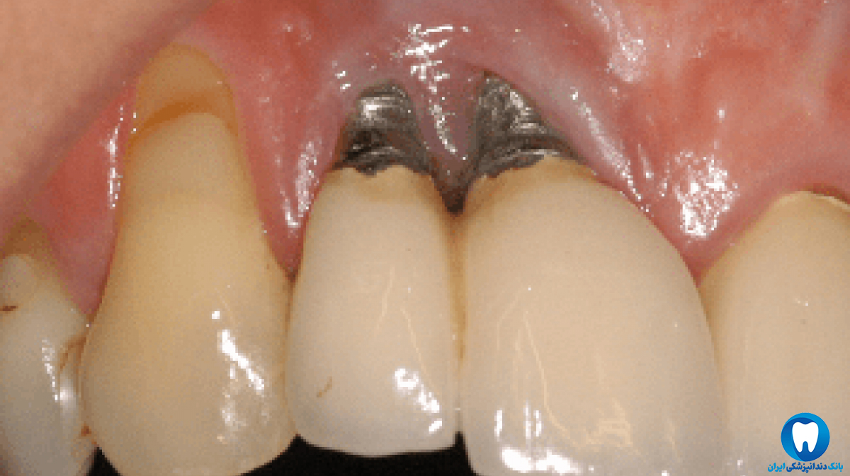برای درد دندان ایمپلنت باید چه کرد