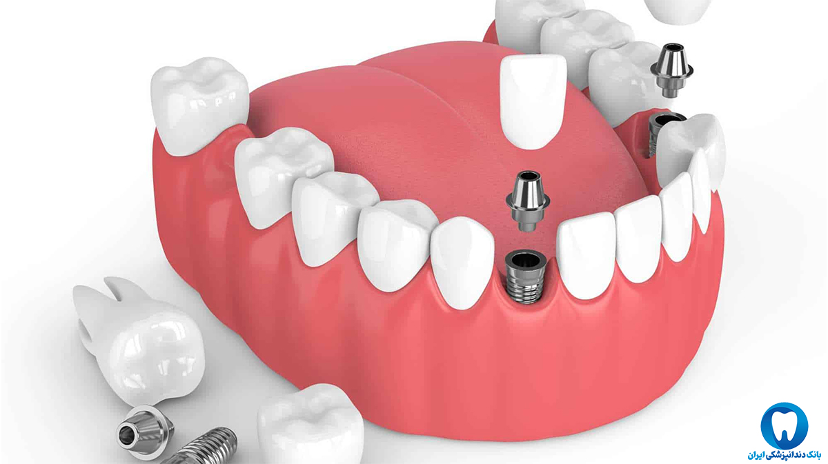 علت درد دندان ایمپلنت شده