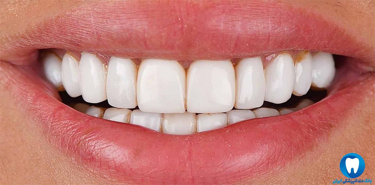 بهترین دکتر کامپوزیت دندان در بندرعباس