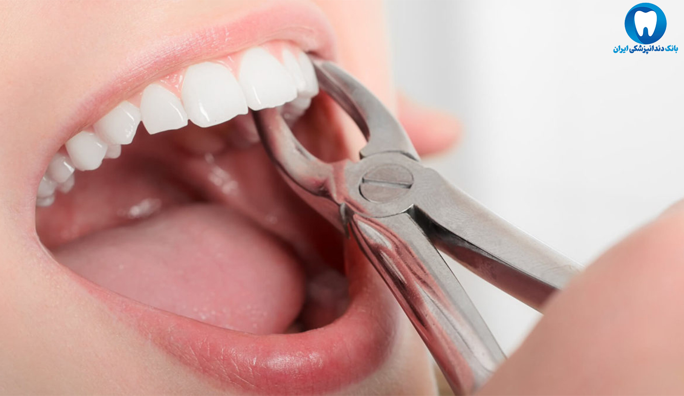 کشیدن دندان برای ایمپلنت
