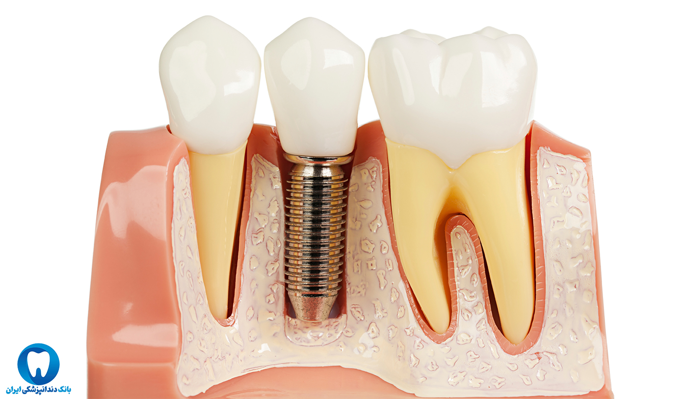 ایمپلنت دندان چند مرحله دارد