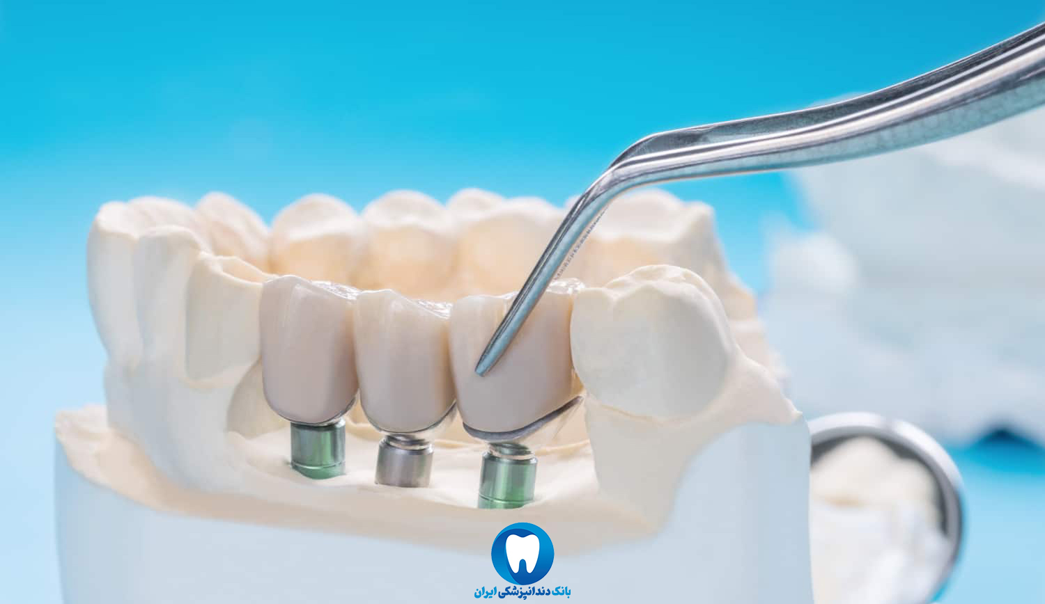 چگونه از دندان ایمپلنت نگهداری کنیم