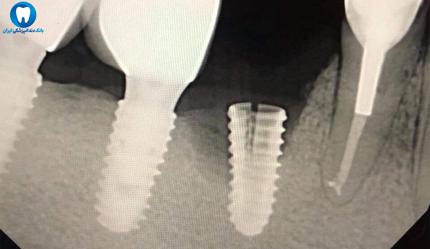 ضرر ایمپلنت دندان