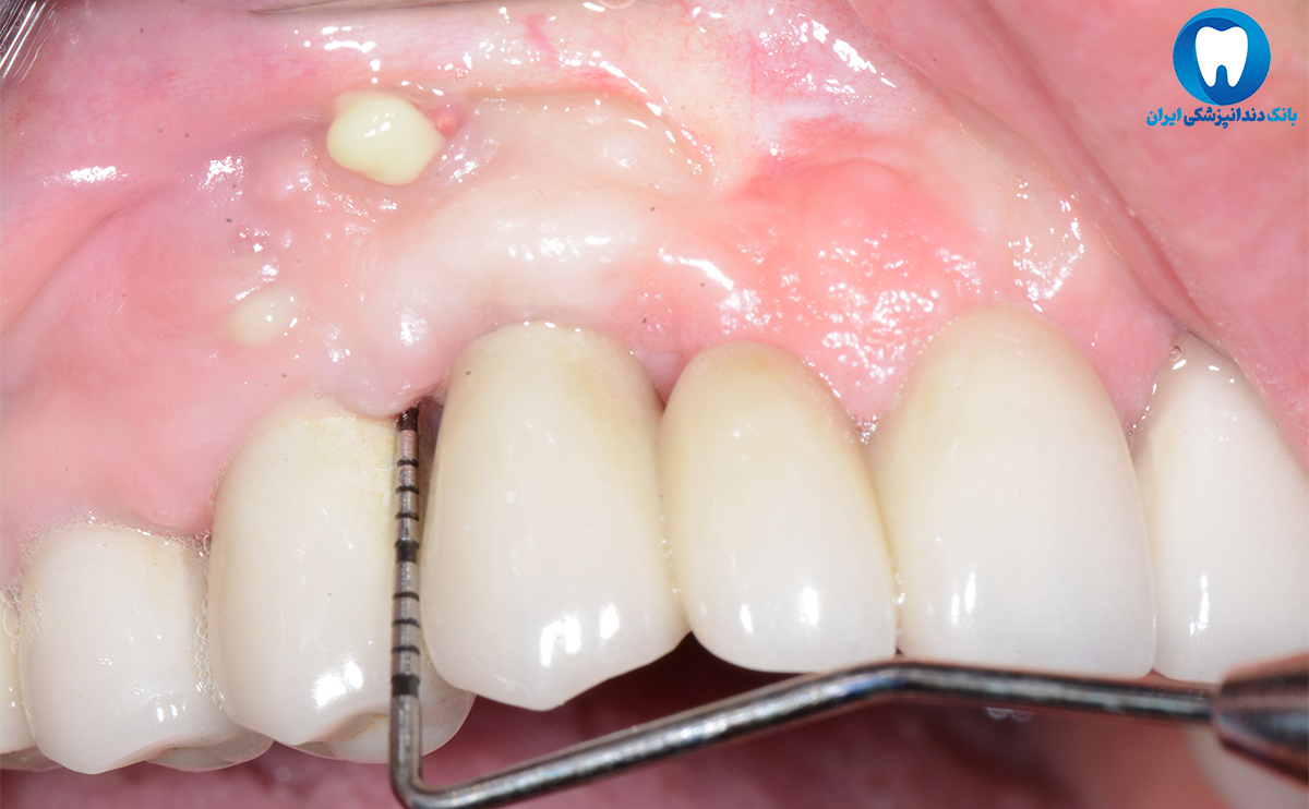 عوارض ایمپلنت دندان ها