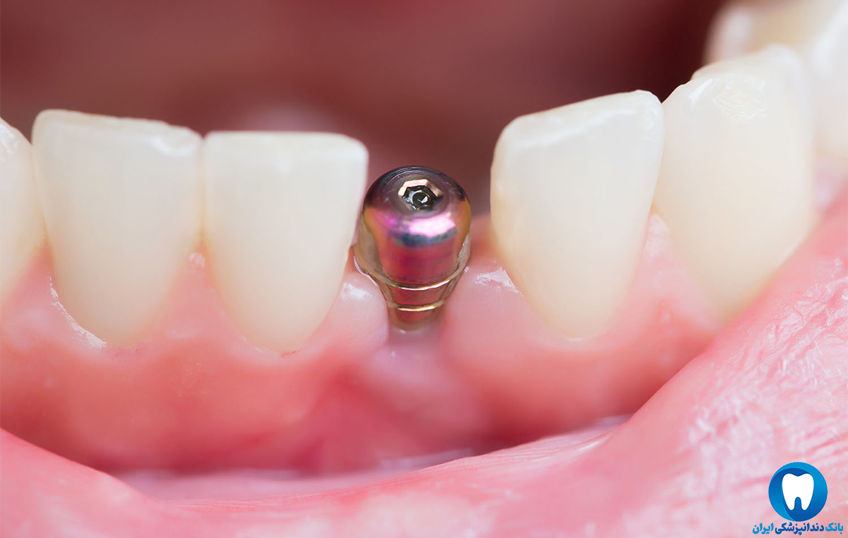 ایمپلنت دندان معمولی