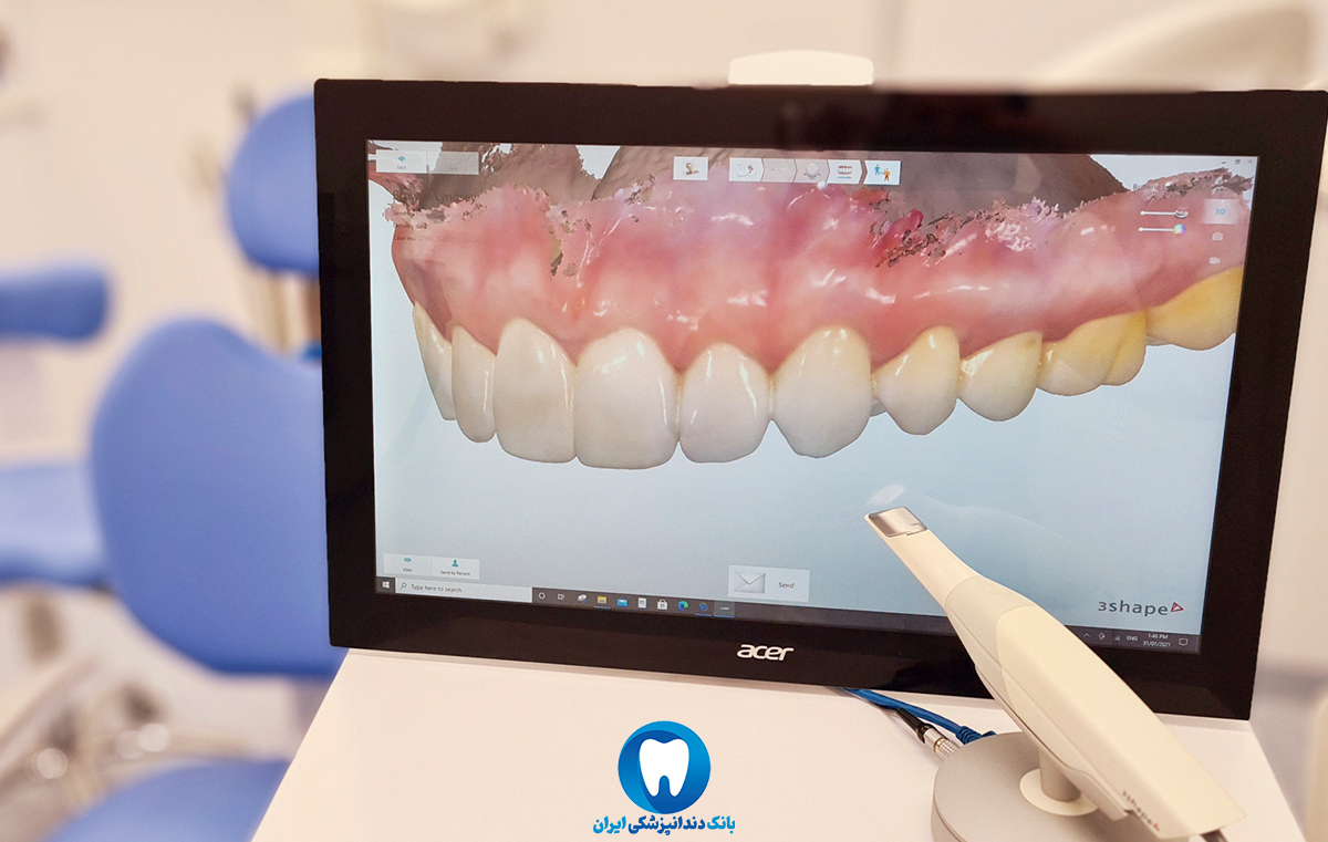 ایمپلنت دندان به روش دیجیتال