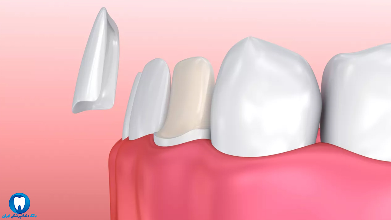 مزایای ایمپلنت دندان نسبت به روکش