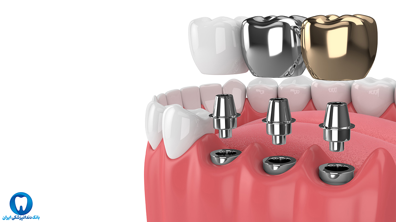 فرق انواع ایمپلنت دندانی