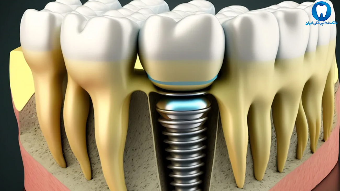 انواع ایمپلنت دندان پزشکی