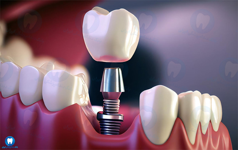 بهترین دندانپزشک متخصص ایمپلنت دندان در آمل
