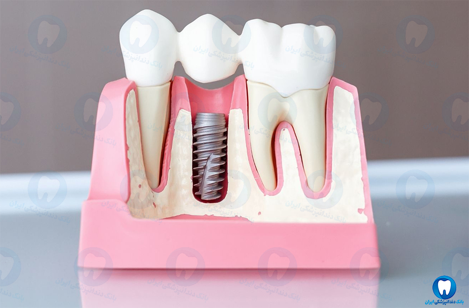 بهترین دندانپزشک متخصص ایمپلنت دندان در بهبهان