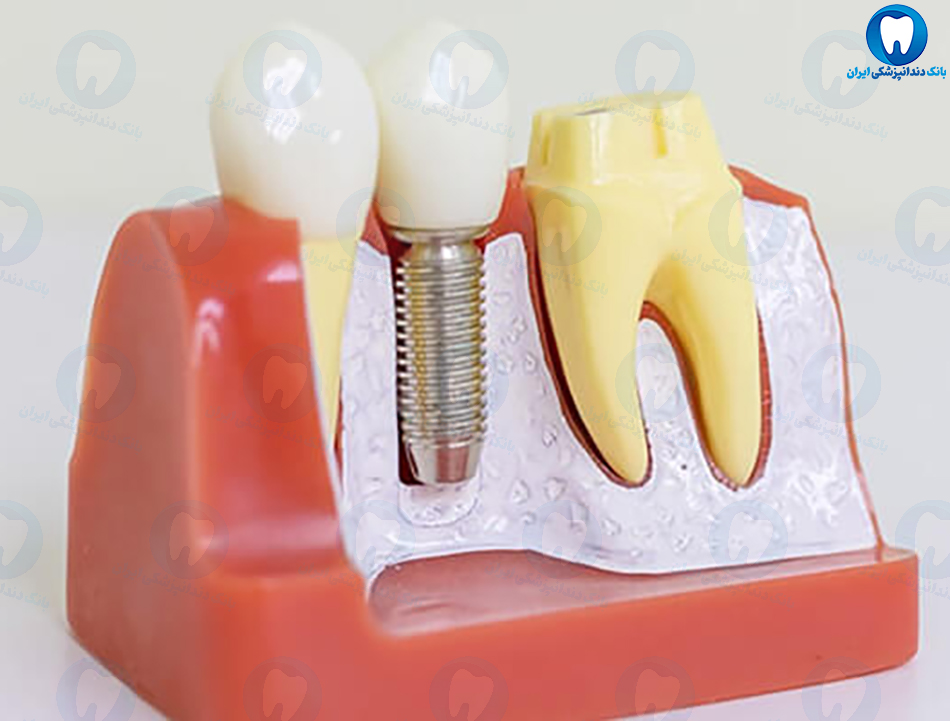 بهترین دندانپزشک متخصص ایمپلنت دندان در بندر انزلی