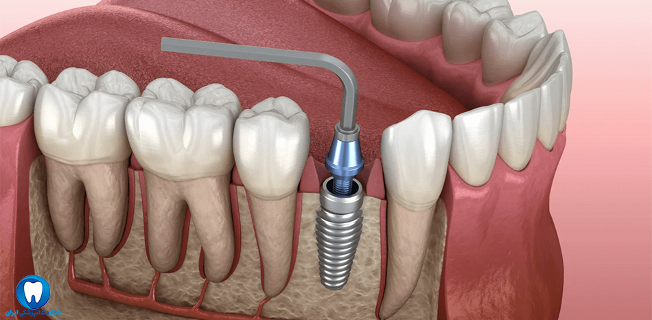بهترین دندانپزشک متخصص ایمپلنت دندان در فولادشهر