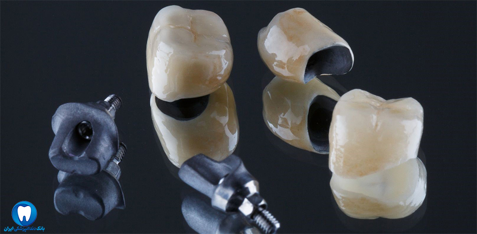 بهترین دندانپزشکی ایمپلنت دندان در فولادشهر