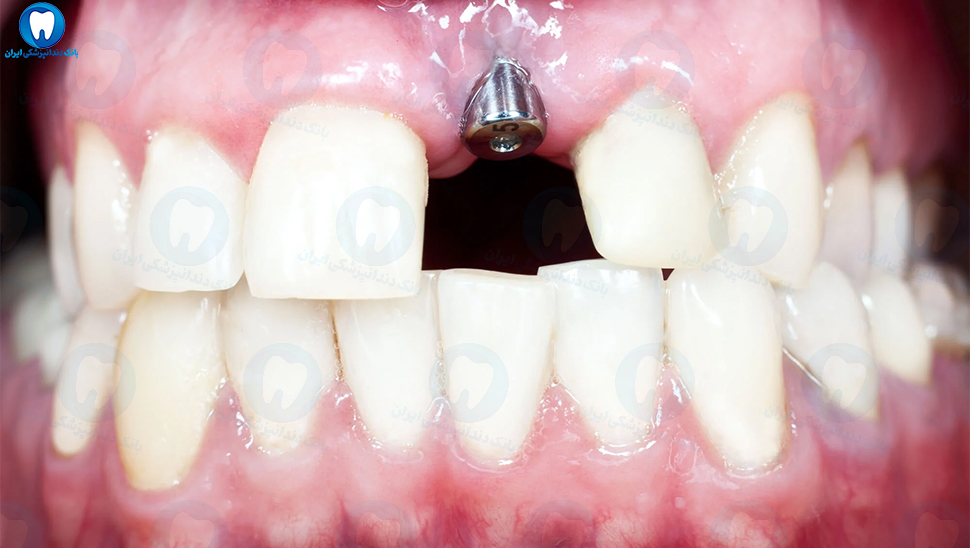 بهترین دکتر ایمپلنت دندان در خوی