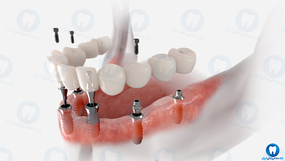 بهترین دکتر دندانپزشک متخصص ایمپلنت دندان در خوی