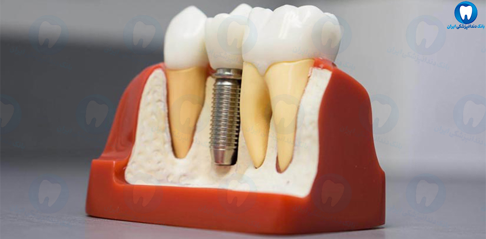 بهترین دندانپزشک متخصص ایمپلنت دندان در لنگرود