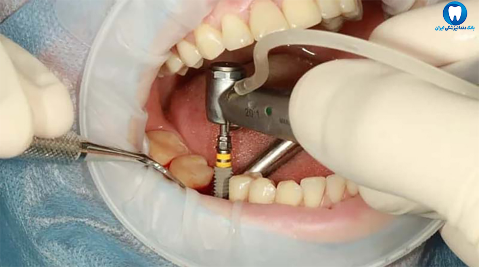 بهترین دندانپزشکی ایمپلنت دندان در ستارخان تهران