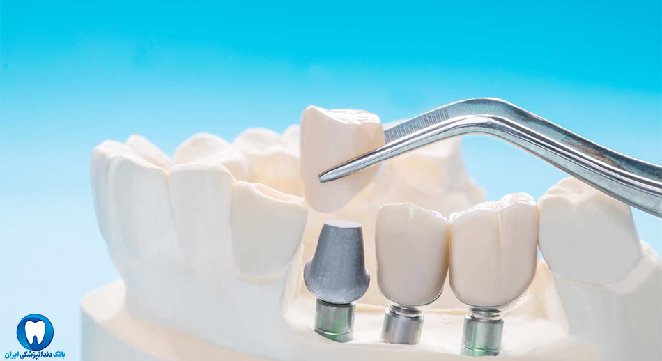 بهترین دندانپزشک متخصص ایمپلنت دندان در شیروان