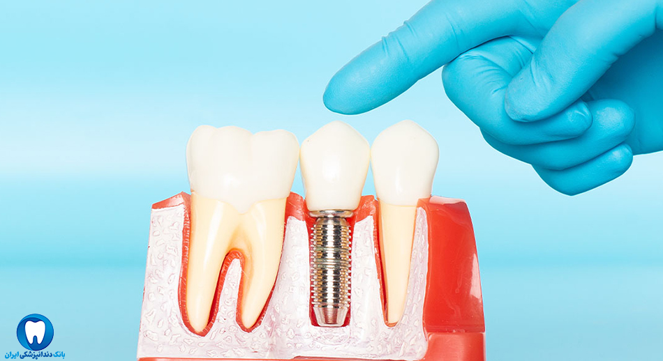 بهترین دکتر دندانپزشک ایمپلنت دندان در شیروان