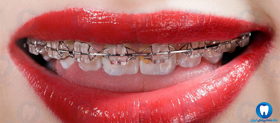 بهترین متخصص ارتودنسی دندان در ساری